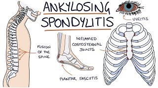 Ankylosing Spondylitis Visual Explanation for Students [upl. by Annodahs486]