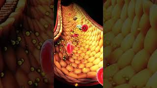 Treating Heart Disease  Part 2  Arteriosclerosis [upl. by Polivy133]