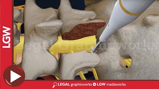 L5S1 Lumbar Discectomy and Fusion Surgery 3D animation [upl. by Ojyllek]