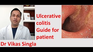 Ulcerative colitis Treatment and Symptoms अल्सरेटिव कोलाइटिस In Hindi Dr Vikas Singla [upl. by Judon]