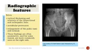 Pagets Disease How to Recognize Medical Documentary [upl. by Llenrahc]