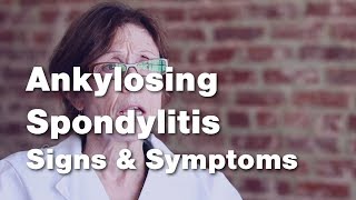 Ankylosing Spondylitis  Signs and Symptoms 2 of 5 [upl. by Caffrey]