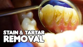 Dental Cleaning EXPLAINED  Stain amp Tartar Removal [upl. by Arondel586]