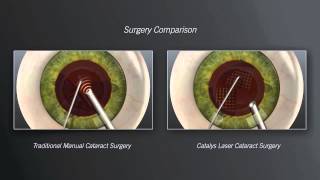 Catalys Laser Cataract Surgery vs Traditional Manual Cataract Surgery  Animation [upl. by Remo523]