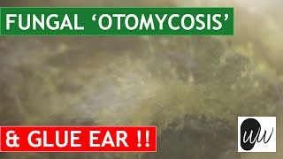 MOST CHALLENGING Otomycosis Fungal Ear Infection Removal from Ear with Glue Ear  370 [upl. by Enelyaj736]