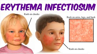 Erythema Infectiosum Fifth Disease [upl. by Tillford]