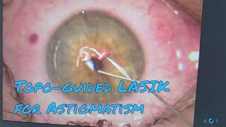 Contoura Vision Laser Eye Surgery for Astigmatism  Topographyguided LASIK PRK [upl. by Burris]