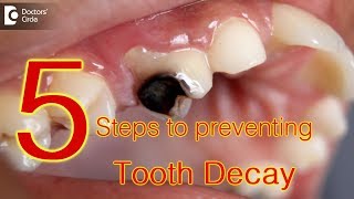 5 Steps to preventing tooth decay  Dr Gopathi Haritha [upl. by Ainitsirk]