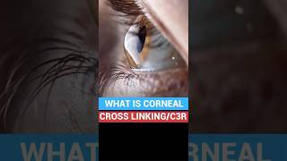 Corneal cross linking C3R  Keratoconus Treatment Cost [upl. by Wylie]