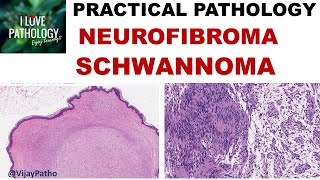 NEUROFIBROMA AND SCHWANNOMA Clinical features amp Morphology [upl. by Gilliette]