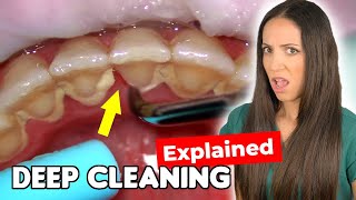 Dental Hygienist Explains Deep Cleaning Procedure [upl. by Oniuqa245]