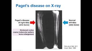 What is Paget’s Disease of Bone and how does bisphosphonate treatment work Dr Daroszewska explains [upl. by Lepine]