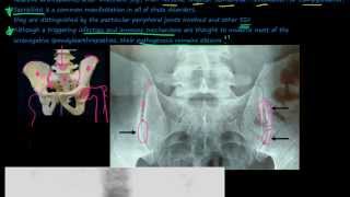 96P Introduction to the Seronegative Spondyloarthropathies [upl. by Meil]