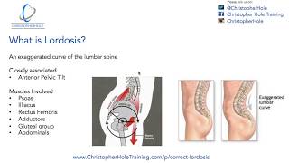 Lordosis Treatment A 3 Step Process [upl. by Dani535]