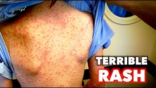 TERRIBLE Full Body Rash  Dr Paul [upl. by Enaid]