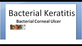 Ophthalmology 111 a Bacterial Keratitis Corneal Ulcer Cornea Bacteria Infective Hypopyon infection [upl. by Laertnom]