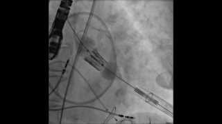 TAVRTranscatheter Aortic Valve Replacement Transapical Deployment [upl. by Idnyl]