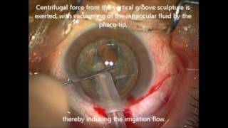 iH during phacoemulsification cataract surgery  ID 124528 [upl. by Isidor176]