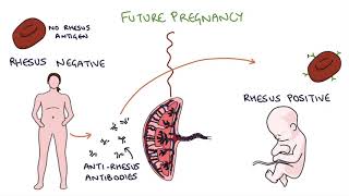 Understanding Rhesus Status and AntiD in Pregnancy [upl. by Sedgewake525]