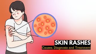 Skin Rash Causes Signs and Symptoms Diagnosis and Treatment [upl. by Enytnoel674]