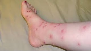 How to Identify an HIV Rash [upl. by Georgette]