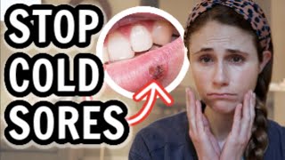 How to treat cold sores FAST Dr Dray [upl. by Yevreh]