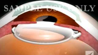 Eye Surgery Cataract with Lens Replacement [upl. by Eniger]