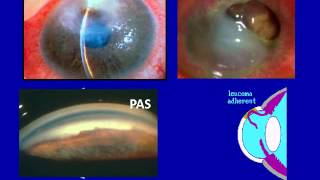 Cornea  2b Corneal ulcer complications [upl. by Dowzall20]