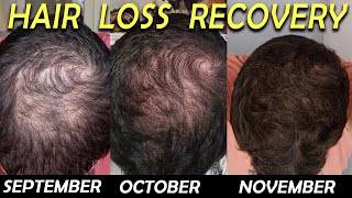 3 Month Hair Loss Reversal with Dutasteride Minoxidil and Saw Palmetto [upl. by Redfield16]