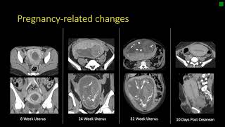 Gynecologic Radiology Anatomy [upl. by Harrow547]