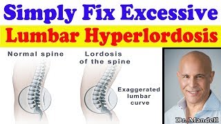 Simply Fix Excessive Lumbar Hyperlordosis  Dr Alan Mandell DC [upl. by Fabiola872]