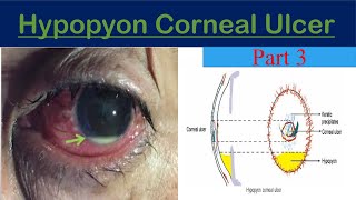 Hypopyon Corneal Ulcer keratitis part 3 [upl. by Karyl528]