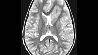 Cortical Dysplasia [upl. by Ellenhoj616]