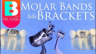 Braces Bands vs Brackets for Molars in Orthodontics [upl. by Valerio]