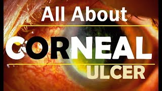 Corneal Ulcer Hindi [upl. by Britney236]