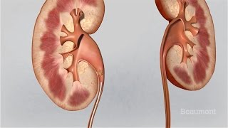 How do kidney stones form [upl. by Phio]