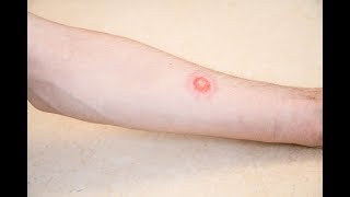 Is it ringworm Signs and symptoms [upl. by Strage550]