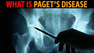 What is Pagets disease [upl. by Fowle]