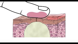 Using glycolic acid to help clear acne  Acneorg [upl. by Oicnoel]