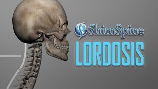 Lordosis [upl. by Azitram]